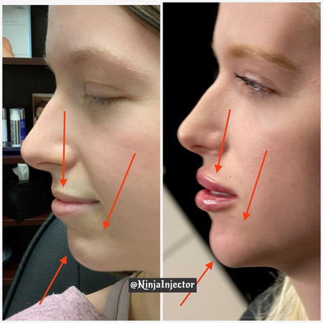 Lip and Chin Filler 2