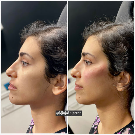 Filler in the Mid face before and after from the other side