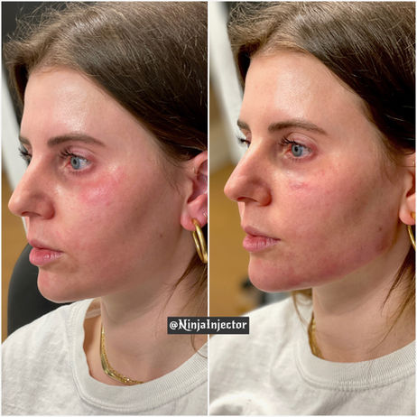 Lower Face Filler