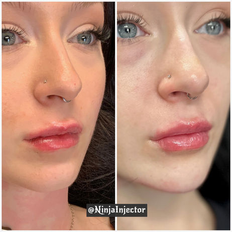 Lips and Chin by Ninja Injector