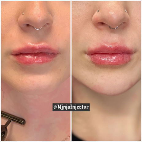 Lips and Chin by Dr. Green