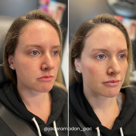 Jade cheek filler before and after