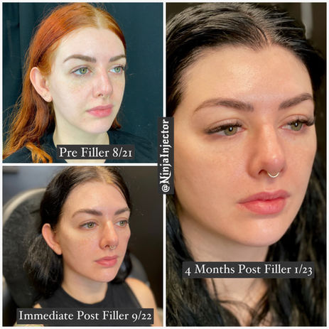 Filler before and after full face 2