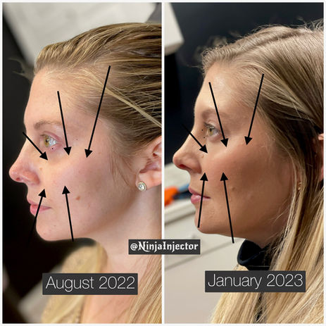 mid face filler side view with arrows left