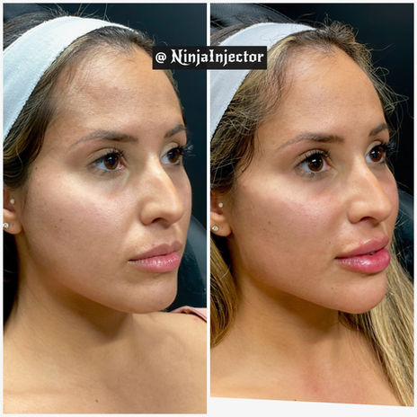 Facial harmonising with filler before and after three quarters view