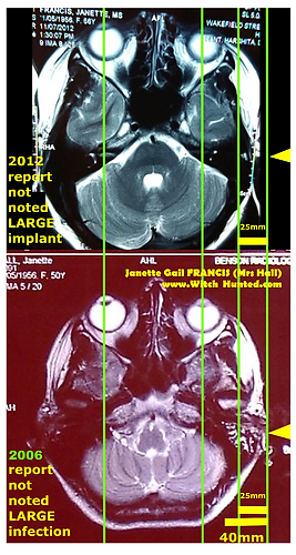 MRI 2006 2012 25mm screw infection AHMED.png