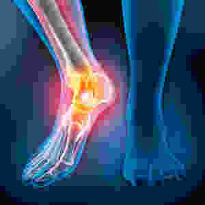 Ankle Injuries from auto accident and slip and fall accident