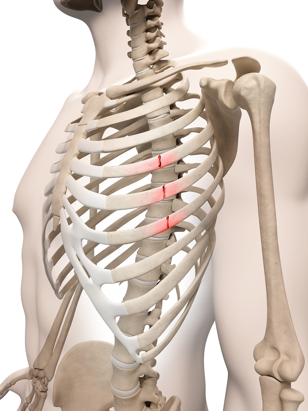 Fractured Ribs caused by an auto accident or slip and fall accident
