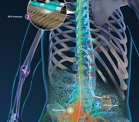 spinal cord stimulator 2_edited.jpg