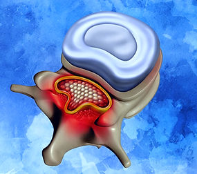 spinal stenosis_edited.jpg