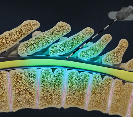 thoracic epidural 1.png