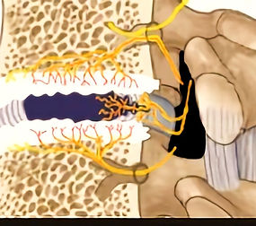 discogenic pain_edited.jpg