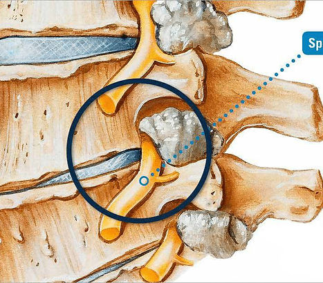 arthritis-of-the-spine-sketch1_edited.jpg