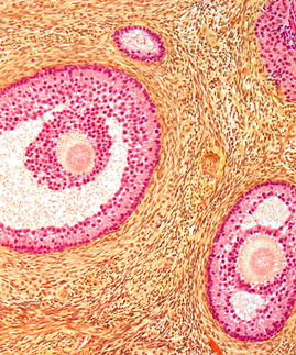 Low AMH poor egg quality.png