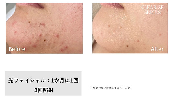 ef_acne-1.jpg