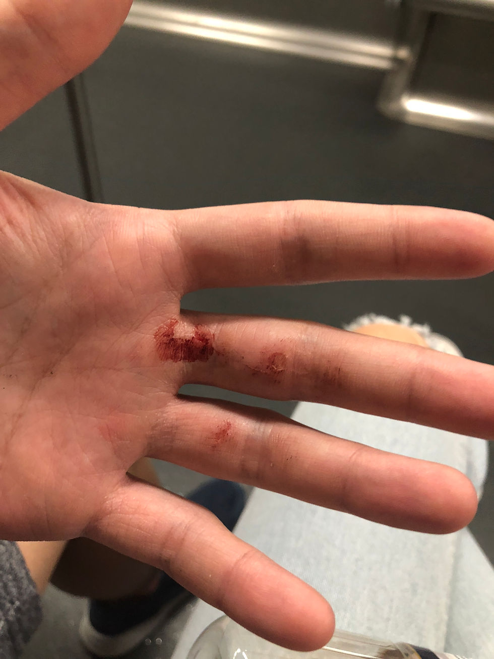 It's easy to get hurt in parkour.