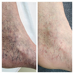Spider Veins.jpg