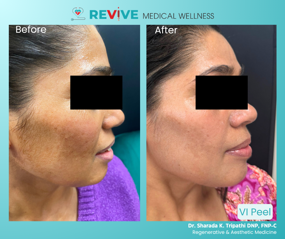 Chemical Peel