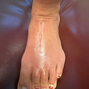 Lisfranc Fracture Treatment and Rehab
