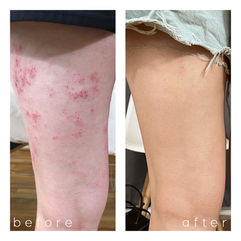 eczema1.jpg