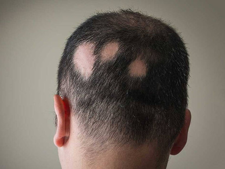 Hair Loss in Chinese Medicine