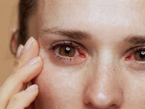Alergia no olho, isso existe? – Parte 3
