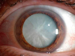  Curiosidades sobre a Cirurgia de Catarata