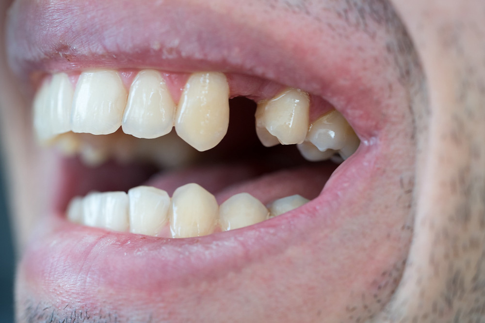 options-to-replace-a-missing-tooth