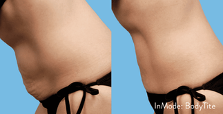 BodyTite™ Before and After Gallery