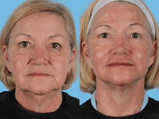 Face Procedures