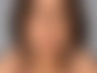 Marionette Lines or Sagging Skin? What Causes Shadows Around the Mouth