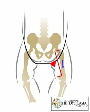 איור של עצמות תינוק כאשר הוא בתנוחה לא נכונה במנשא