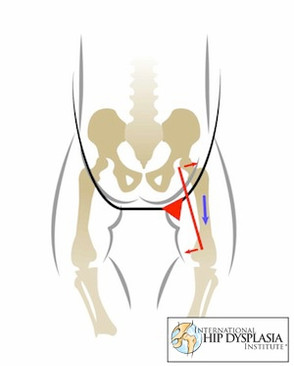מפרקי התינוק כאשר הוא בתנוחת תלייה שהיא לא בטיחותית