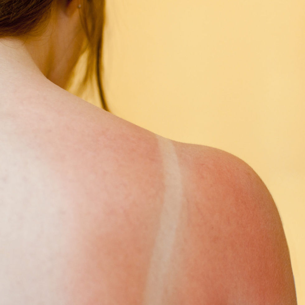 Application d'huile Ianthis Cica Concentré sur la peau, contre les coups de soleil, apaisant et assainissant