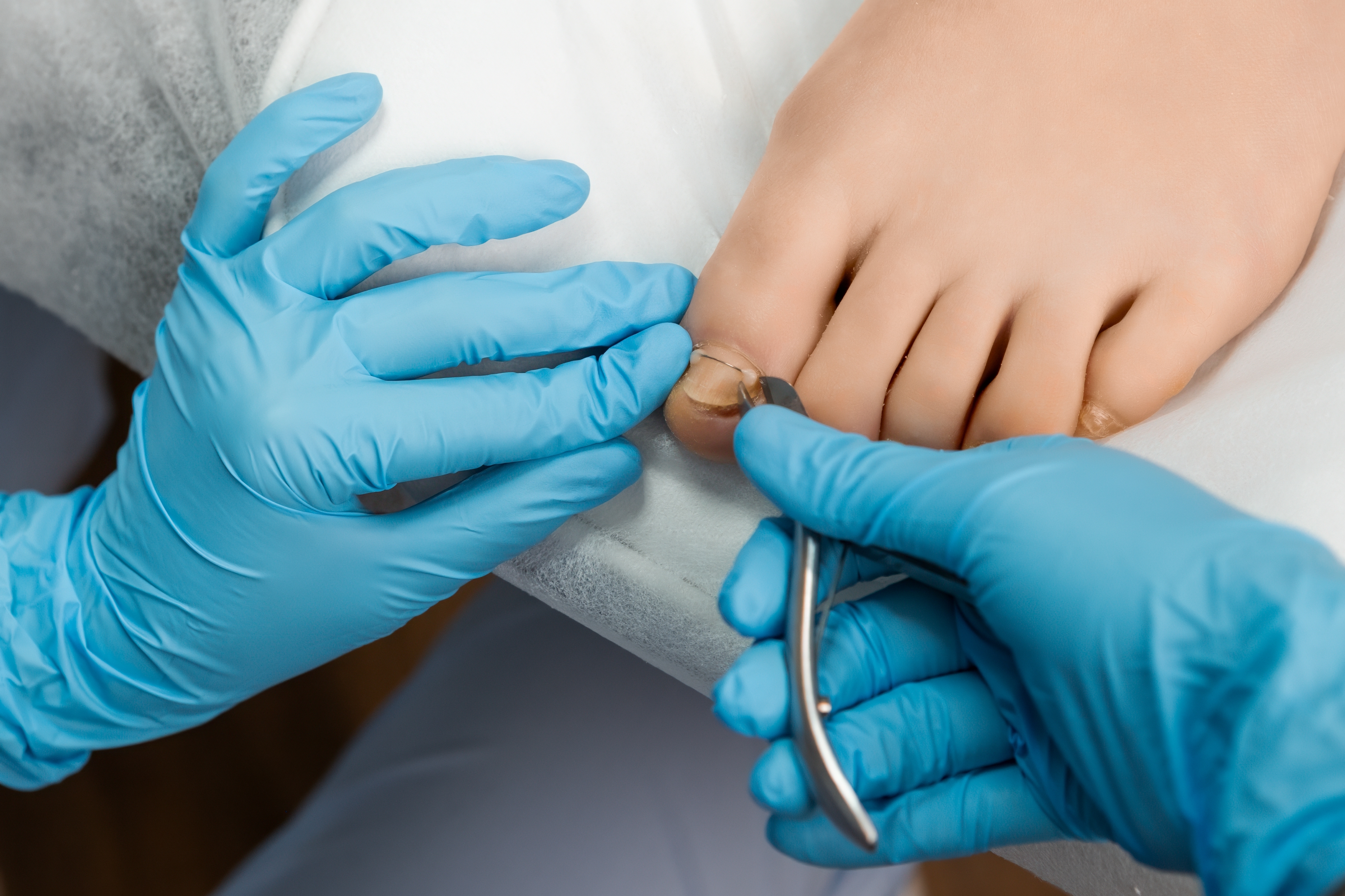 The podologist cut ingrown toenail with nippers Toe nail dressing .jpg