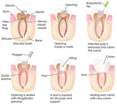 Desvitalización dental las Palmas, devitalización