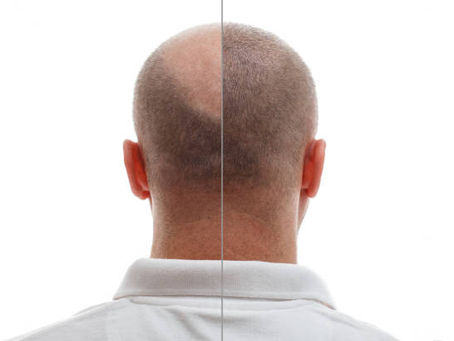 Unlocking Confidence: A Comprehensive Guide to Hair Transplants in Riyadh