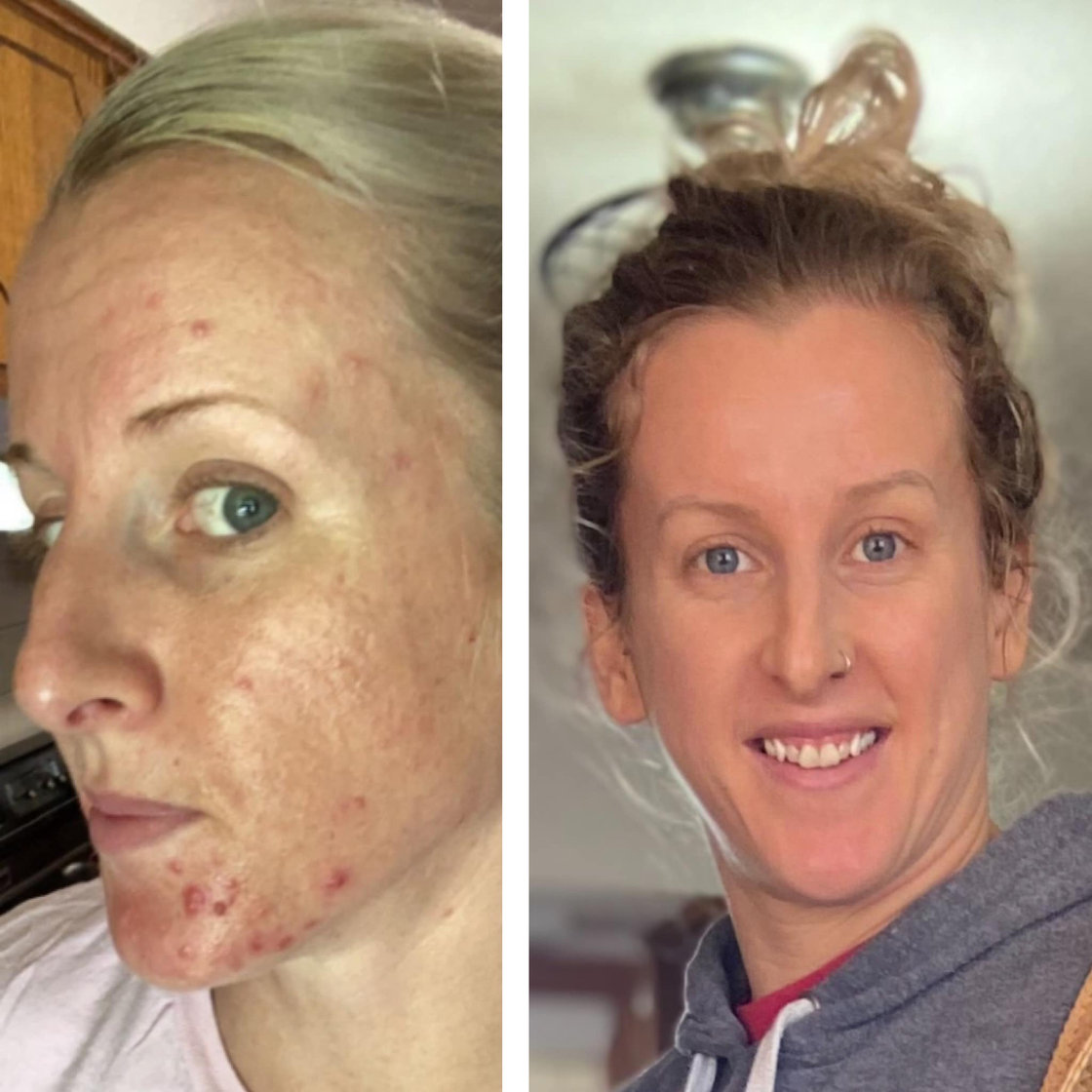 Testimonial Related To Acne