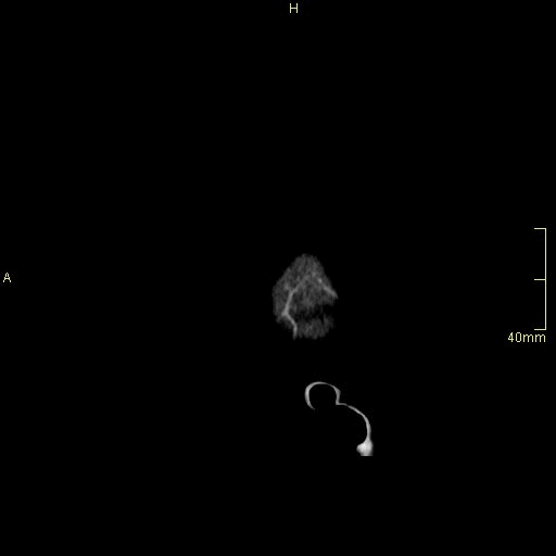 sagittal.gif