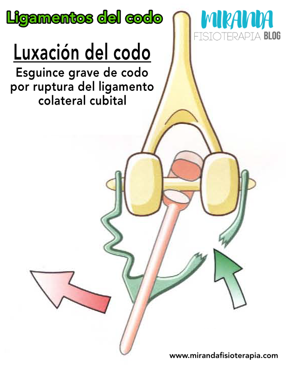 Ligamentos del codo: luxación del codo y esguince de codo por ruptura del ligamento colateral cubital
