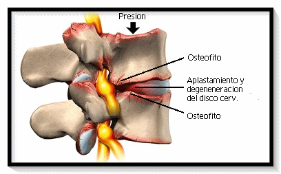 inestabilidad segmentaria