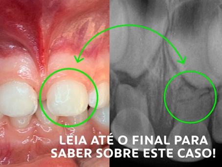 A CRIANÇA BATEU O DENTE! E AGORA? O QUE FAZER?