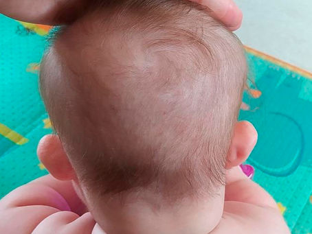 PEQUENAS ASSIMETRIAS NO CRÂNIO DO BEBÊ – MUDANDO HÁBITOS