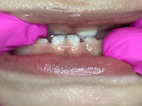 MORDIDA CRUZADA: A IMPORTÂNCIA DA AVALIAÇÃO PRECOCE