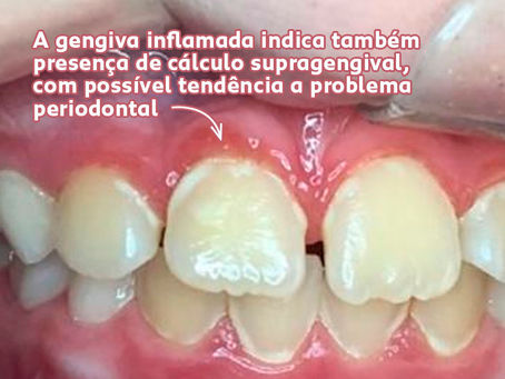 CÁLCULO DENTAL NA INFÂNCIA