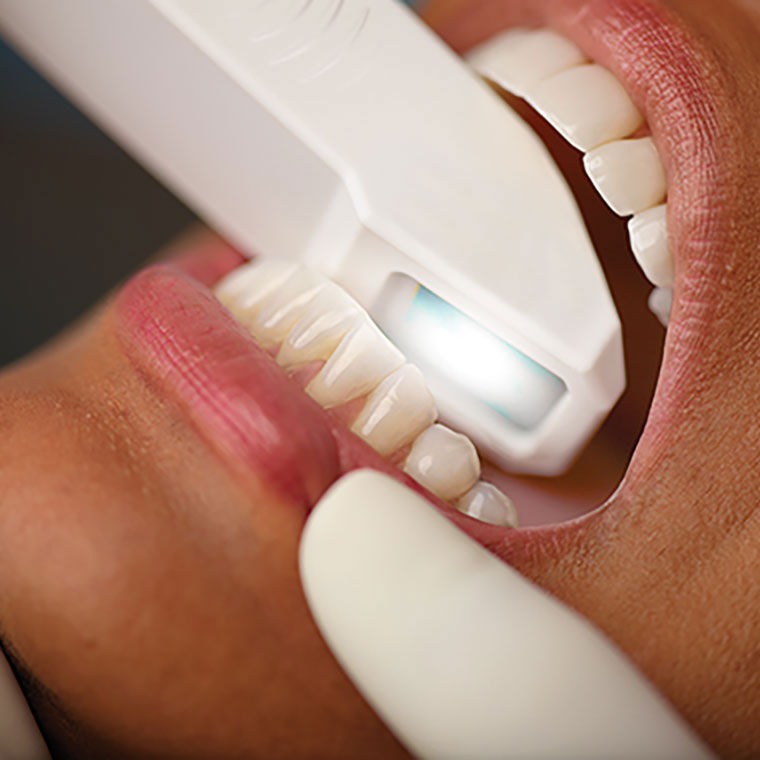 O avanço da tecnologia tem transformado diversos setores, incluindo a odontologia. Uma das inovações que tem ganhado destaque é o escaneamento intraoral, uma técnica que revoluciona
