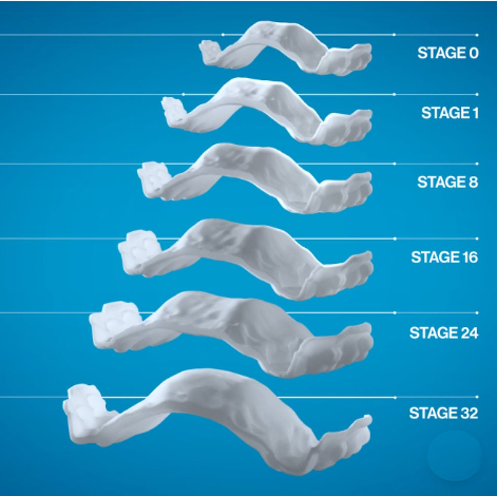 Invisalign Palatal Expander | OrtodontistaCuritiba