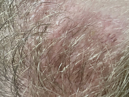 Does PRP Improve Hair Transplant Results? What a New April 2026 Study Shows