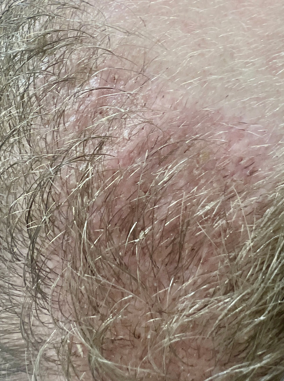 Does PRP Improve Hair Transplant Results? What a New April 2026 Study Shows