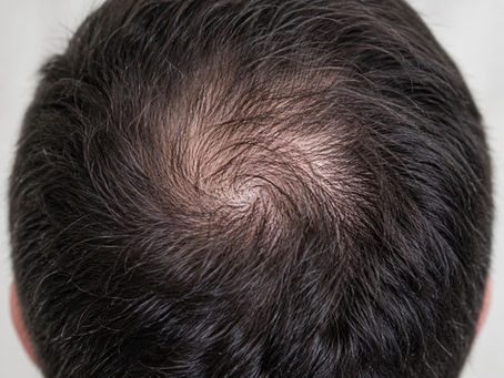 Beyond Beard Hair: Can Body Hair From Other Areas Help a Hair Transplant?